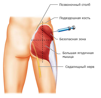 Куда делать укол в угодицу