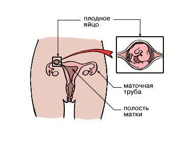 Признаки внематочной беременности