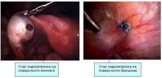 Эндометриоз