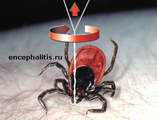 удаление клещей ниткой