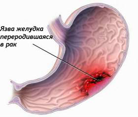 Язва желудка переходящая в рак