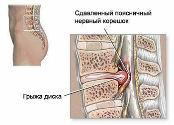 Боли в спине, грыжа диска, протрузия диска, Бехтерева болезнь, боль в крестце, боль в ноге, боль в пояснице, грыжа диска, дисцит, ишиас, люмбаго, межрёберная боль, остеохондроз, протрузия диска, ретролистез, слабость в ноге, спондилез, спондилолистез, Шеермана-Мау болезнь, лечение грыжи, лечение позвоночника, лечение остеохондроза, боль в спине, спина без боли, радикулит, позвоночникболезни лечение, болезни позвоночника, болезнь позвоночника, грыжа, грыжа диска, грыжа диска лечение, грыжа лечение, грыжа методы лечения, грыжа позвоночника, грыжа позвоночника лечение, грыжа симптомы, грыжа шейного отдела, грыжа шморля, грыжа шморля лечение, грыжи, грыжи лечение, грыжи позвоночника, грыжу, заболевания лечение, как лечить грыжу, лечение грыж, лечение грыж позвоночника, лечение грыжи, лечение грыжи диска, лечение грыжи позвоночника, лечение межпозвонковой грыжи, лечение межпозвонковых грыж , лечение межпозвоночной грыжи, лечение межпозвоночной грыжы, лечение межпозвоночных грыж, лечение позвоночной грыжи, лечение позвоночных грыж, лечение пролапса, лечение протрузии, лечения межпозвонковой грыжи, лечения межпозвоночной грыжи, медицина лечение, межпозвонковая, межпозвонковая грыжа лечение, межпозвонковой грыжи, межпозвоночная, межпозвоночная грыжа лечение, межпозвоночной, межпозвоночные, методы лечения грыжи, мышцы позвоночника, позвонковая, позвоночная, позвоночная грыжа лечение, позвоночная грыжа лечение физкультурой, пролапс, протрузии, протрузия, секвестр, симптомы грыжи, симптомы лечение, упражнения для лечения грыжи, шморля, шморля лечение, лечить протрузию диска в Москве, болит протрузия, боль от протрузии, как лечат, как лечить, где лечат, где лечить