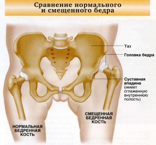 Сравнение нормального и смещенного бедра