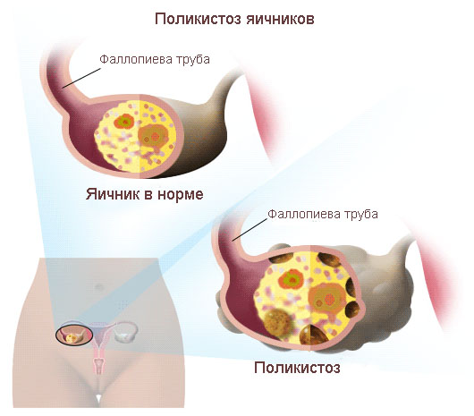 что такое поликистоз яичников