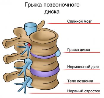 Протрузия