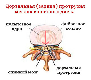 дорзальная протрузия