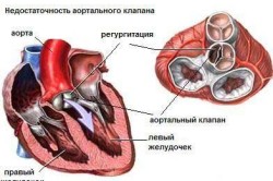 Врожденные пороки сердца