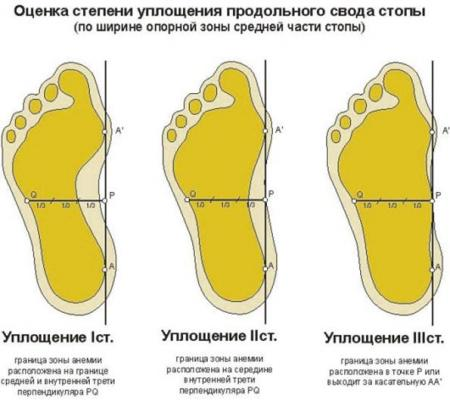 степени плоскостопия
