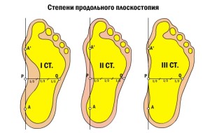 Как эффективно вылечить плоскостопие 2 степени