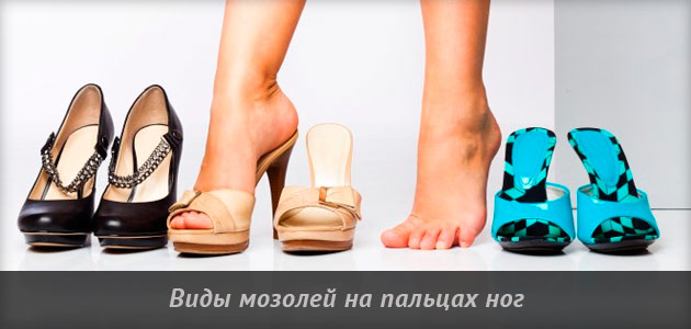 какие мозоли бывают на ногах