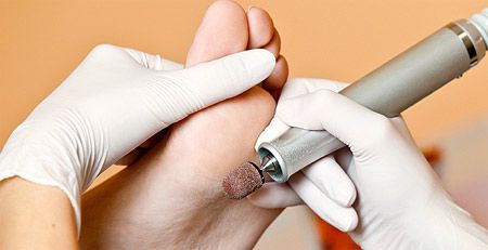 как удалить мозоль на пальце ноги