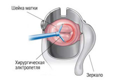 Схема прижигания эрозии шейки матки