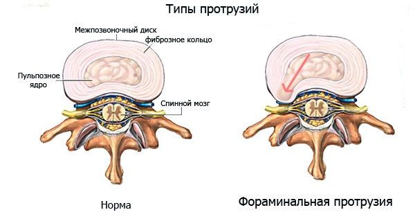 типы протрузий