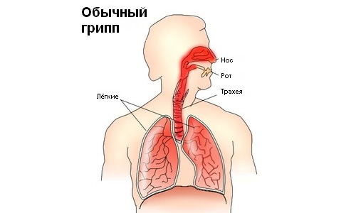 Заболевание гриппом