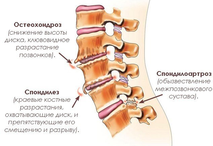 Лечение болезней крестцового отдела