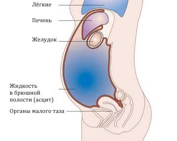 Асцит при циррозе