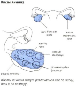 виды кисты яичника