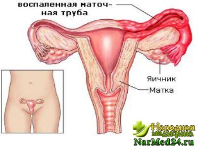 Причины воспаления яичников