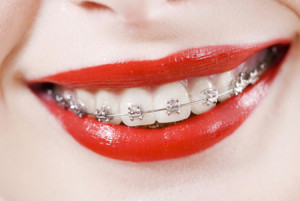 braces3