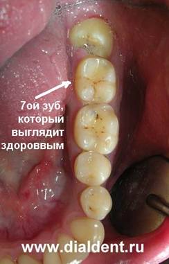 коварный зуб мудрости