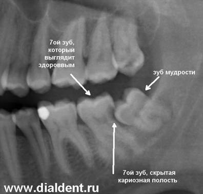 опасный зуб мудрости