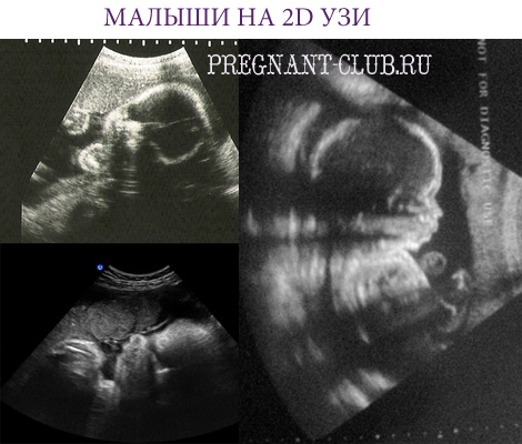 2D узи плода на 29 неделе