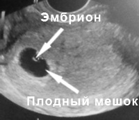 Шестая неделя беременности