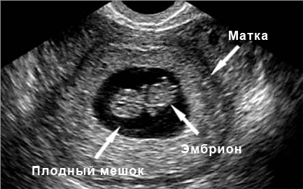 Шестая неделя беременности