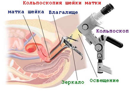 колькоскопия