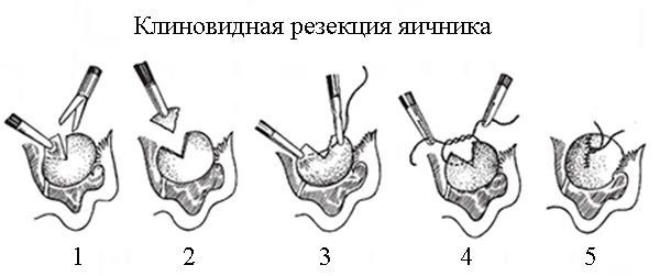 Техника выполнения клиновидной резекции яичника