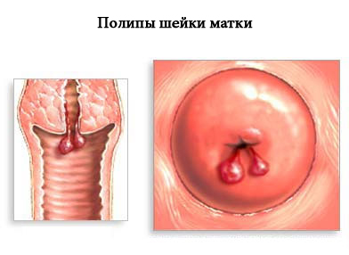 полип шейки матки