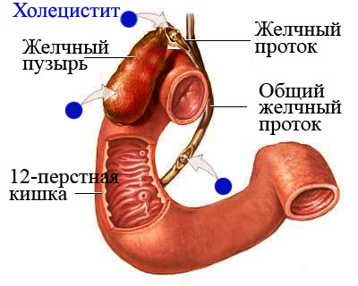 Холецистит бескаменный хронический