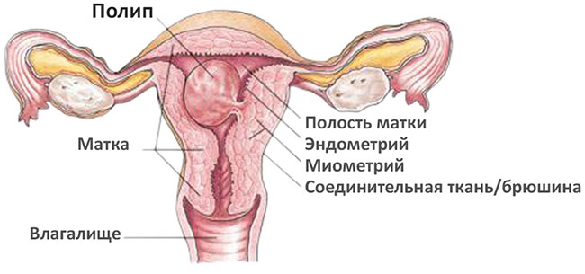 полип эндометрия причины