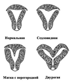Двурогая матка бывает полной, неполной и седловидной формы