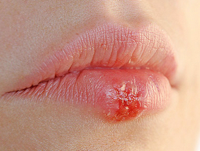 herpes.jpg